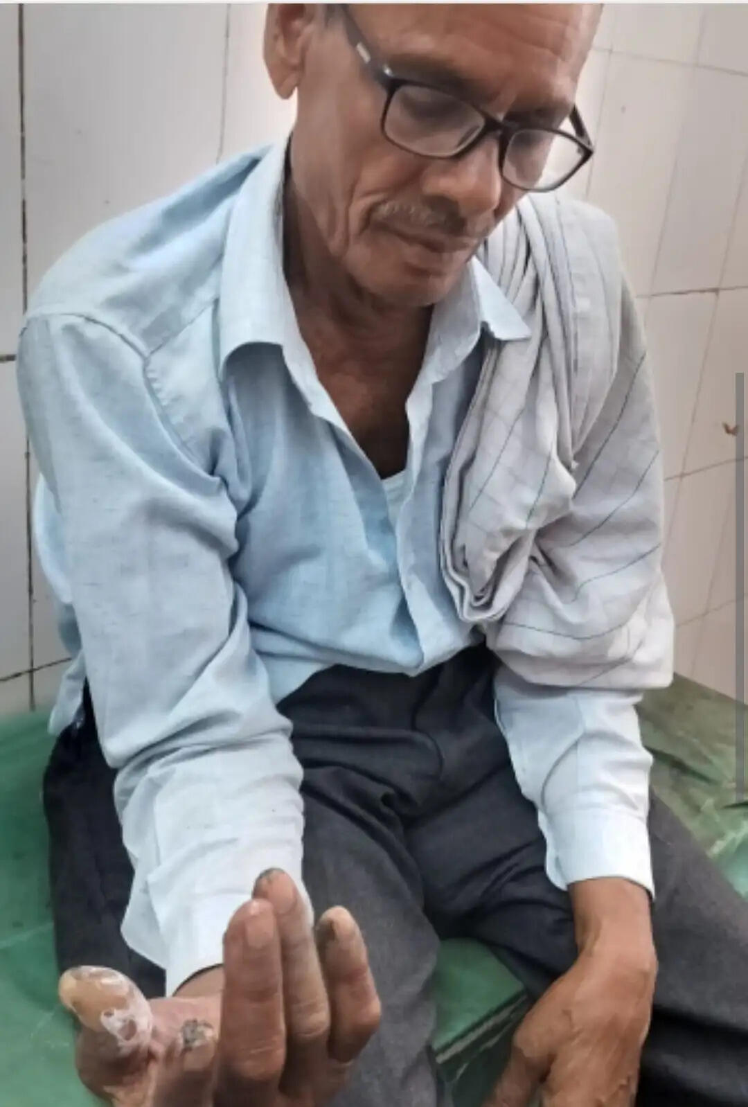 देवरिया में कूड़े के ढेर में लगी आग बनी जानलेवा, बाइक सवार पिता,बेटा और बेटी झुलसे