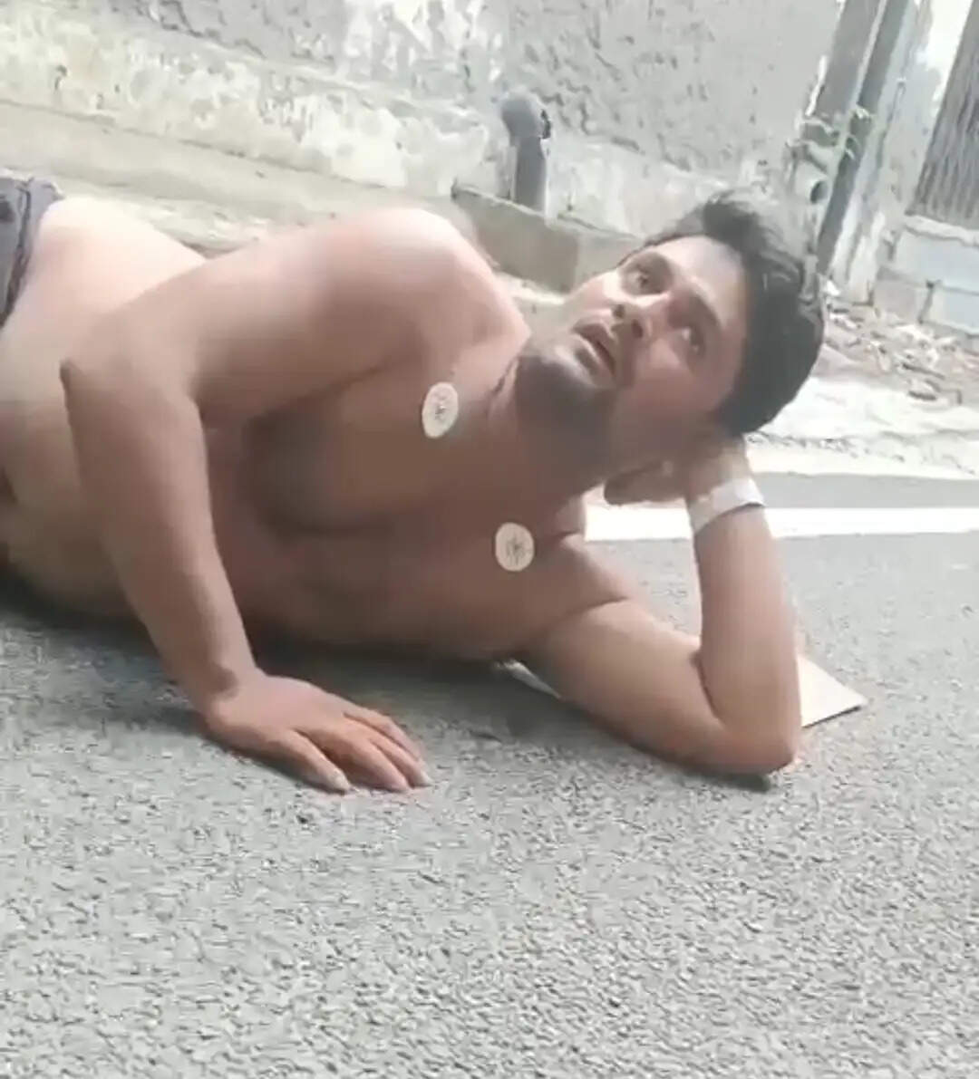 बागपत में कुत्ता काटने से युवक की मौत, 55 लोगों ने लगवाए एंटी रेबीज इंजेक्शन