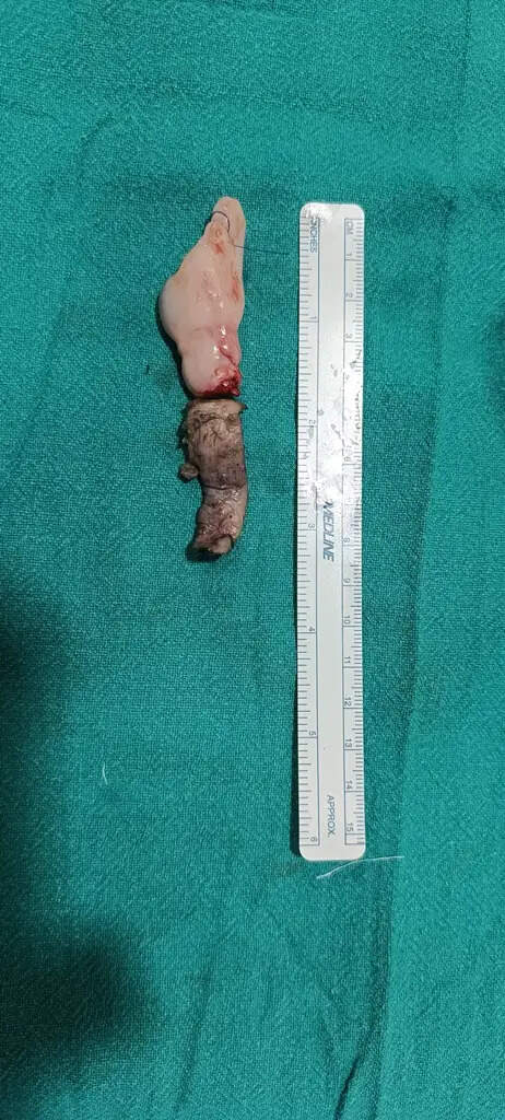 बीएचयू में डेढ़ वर्ष की बच्ची के ट्यूमर का सफल आपरेशन,हृदय को खोलकर निकाला