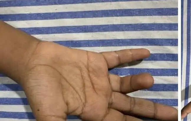 देवरिया मेडिकल कॉलेज में पीड़ित बालक का सफल ऑपरेशन