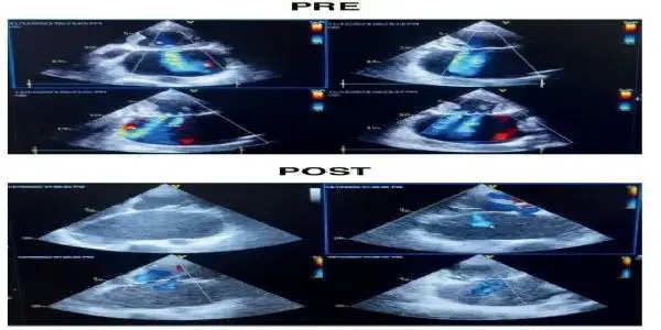 एसएसबी हॉस्पिटल फ़रीदाबाद में मित्रा क्लिप से बचाई गंभीर मरीज की जान