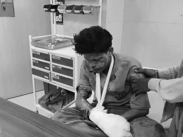 रायसेन में गज कुंडी में बारूद भरते समय विस्फोट, दो किशोर झुलसे,&nbsp;अस्पताल में इलाज जारी