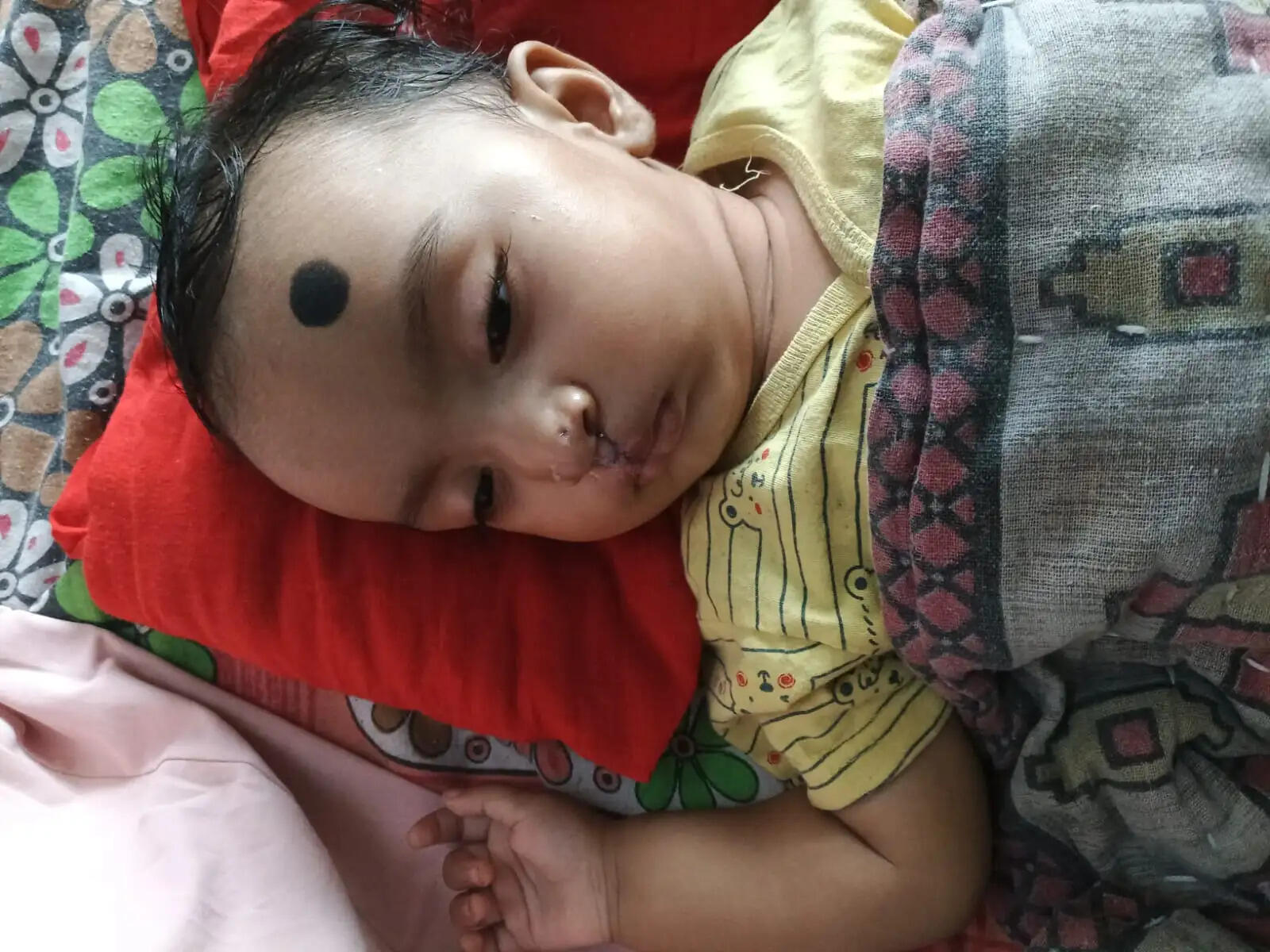 कटे होंठ-तालू के साथ जन्मी अनीशा को मिला नया जीवन