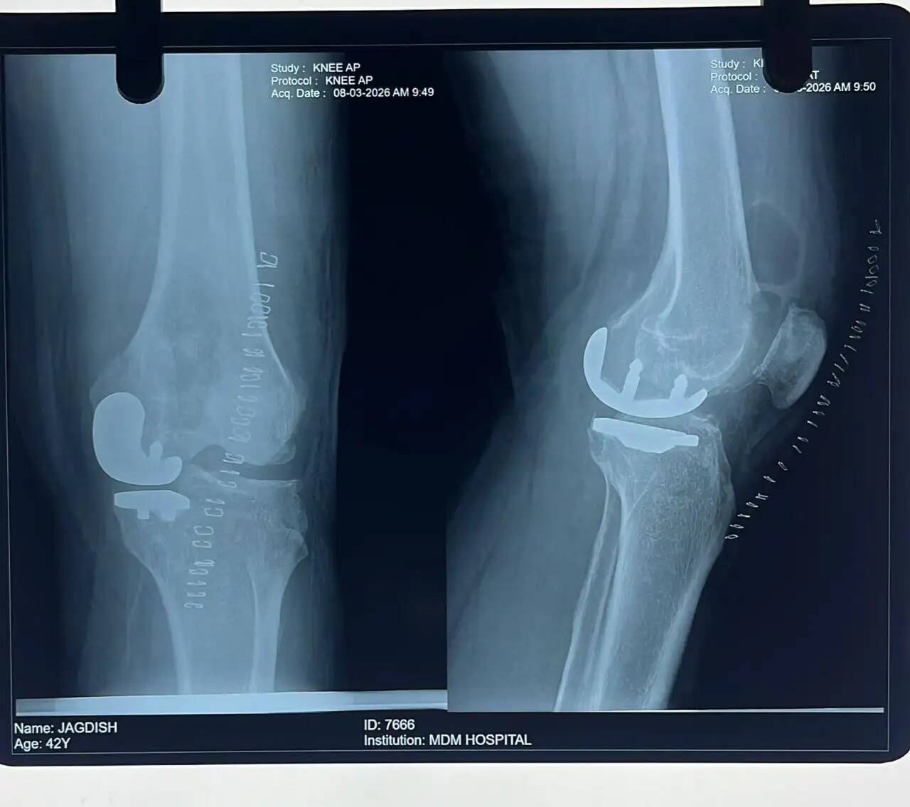मथुरादास माथुर अस्पताल में पहली बार की यूनिकंडाइलर नी रिप्लेसमेंट सर्जरी