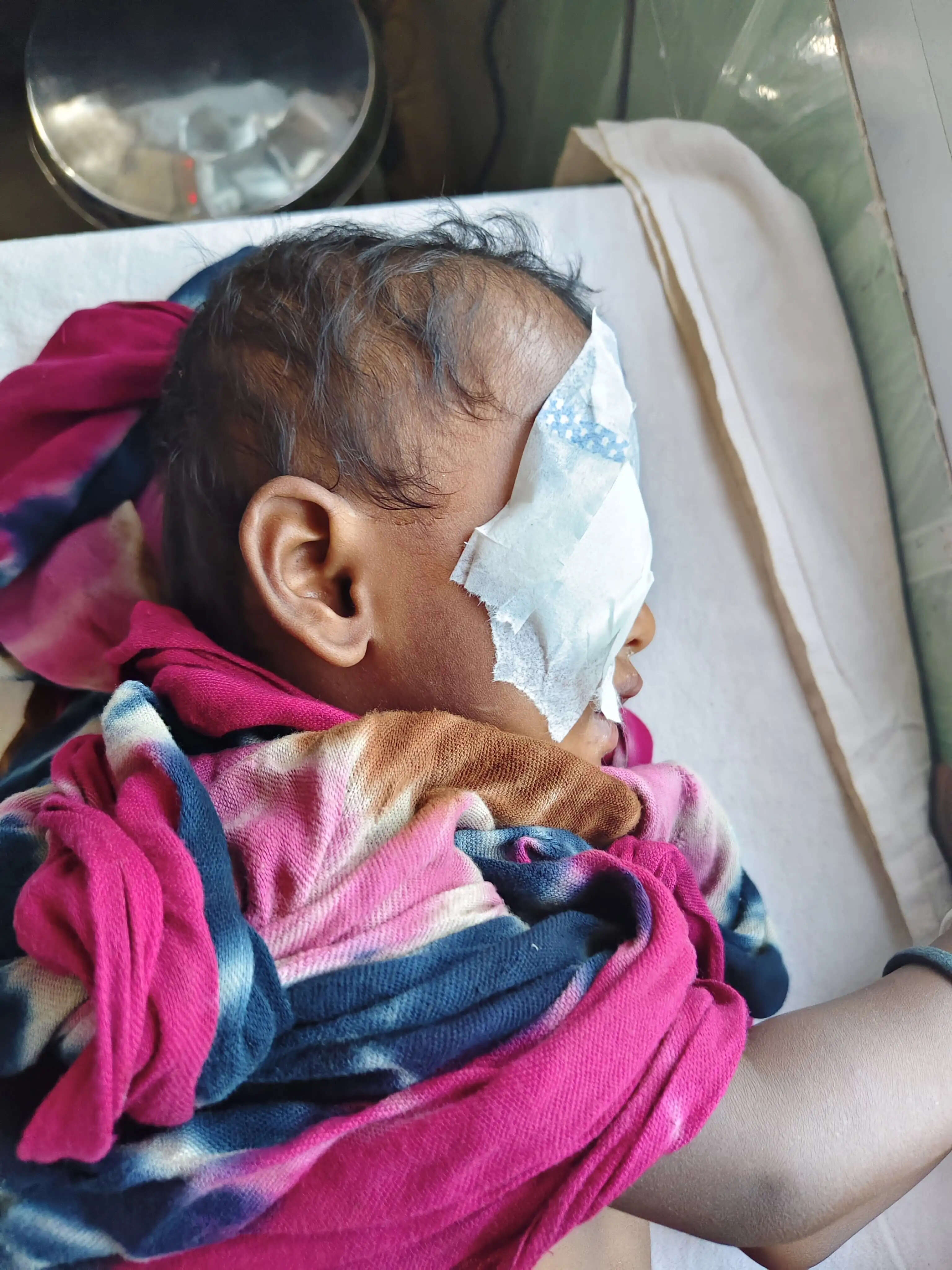 नहलाते समय दो साल के बच्चे की आंख के पलक में फंसी जीभी
