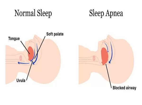 अब एडवांस एमआरआई से ही स्लीप एपनिया का चलेगा पता