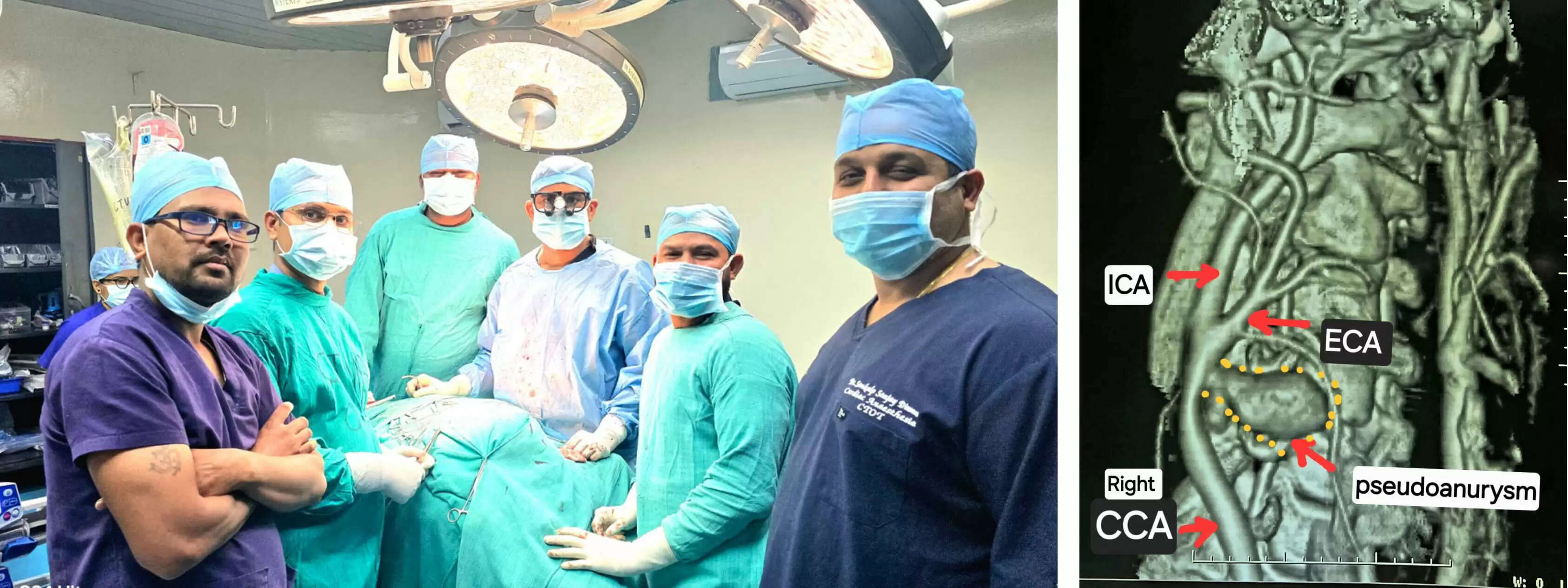 स्पॉन्टेनियस कैरोटिड आर्टरी रप्चर का छत्तीसगढ़ के&nbsp;अम्बेडकर&nbsp;अस्पताल&nbsp;में हुआ&nbsp;सफल उपचार