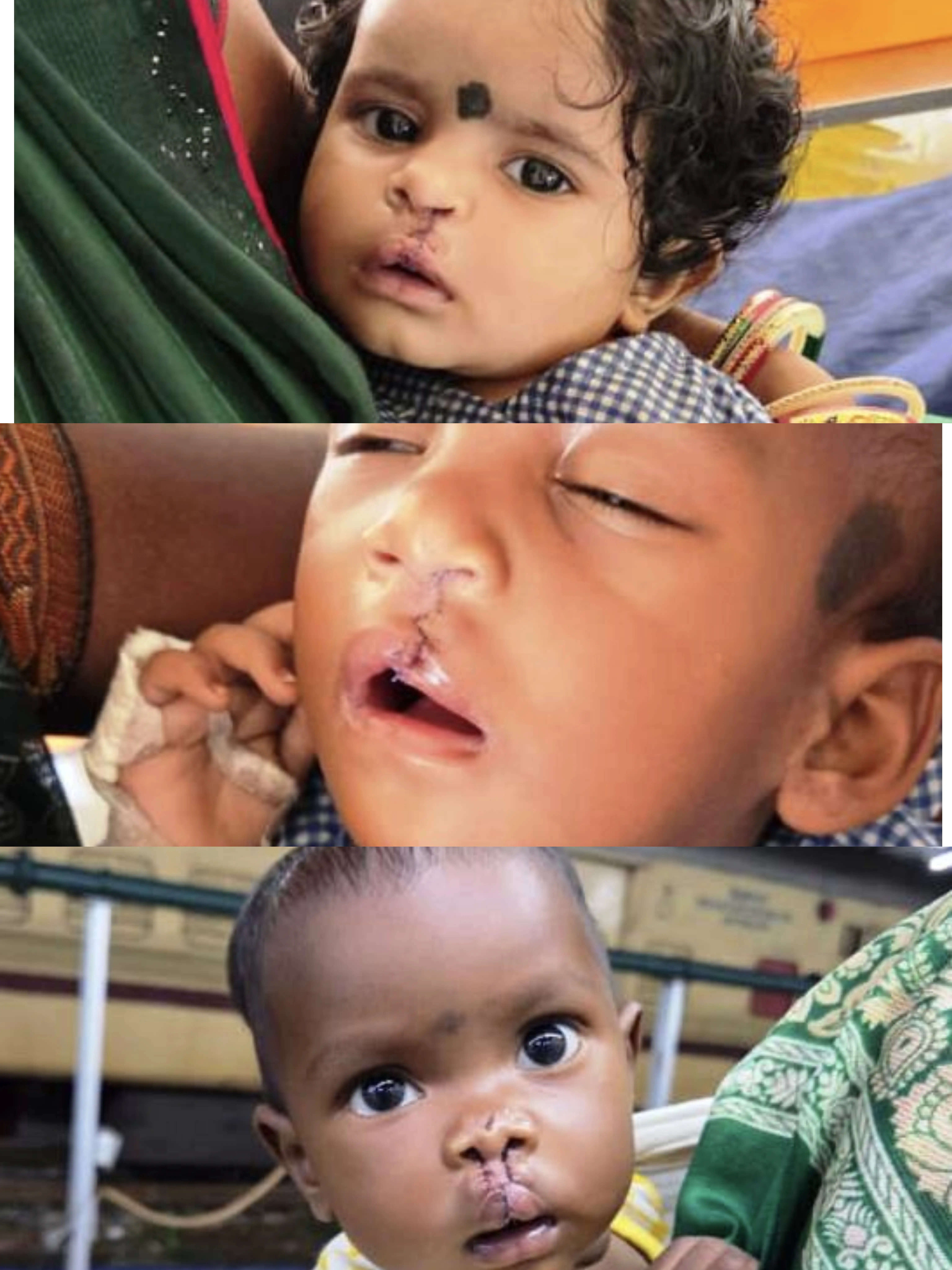 आरबीएसके से तीन मासूमों को मिली नई मुस्कान, रायपुर में निशुल्क हुई क्लेफ्ट लिप-पैलेट सर्जरी