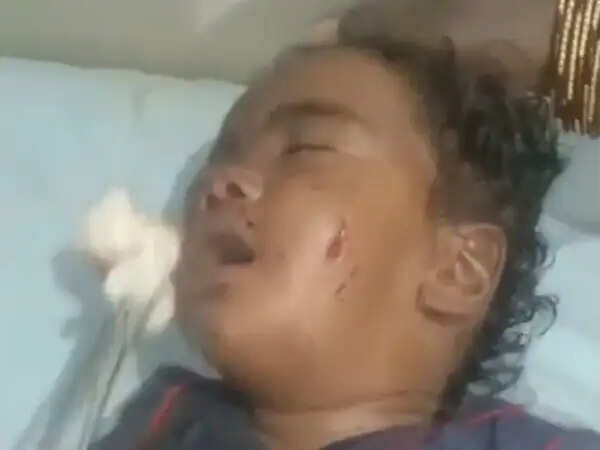 उमरिया : आवारा स्ट्रीट डॉग का हमला, 6 माह का मासूम गंभीर रूप से घायल, जिला अस्पताल में भर्ती