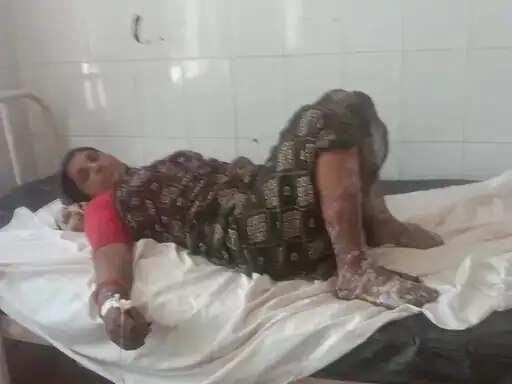 अनूपपुर: खाना बनाते फटा सिलेंडर घर-दुकान में लगी आग, महिला झुलसी