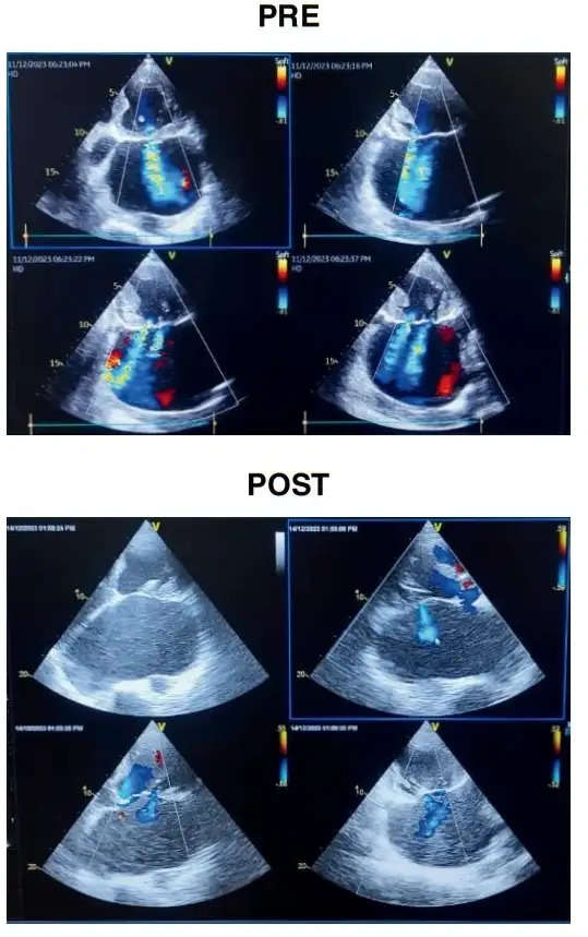 एसएसबी हॉस्पिटल फ़रीदाबाद में मित्रा क्लिप से बचाई गंभीर मरीज की जान