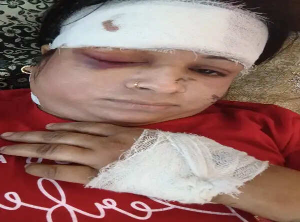 लखनऊ में बंदर ने महिला पर किया हमला, 25 टांके लगे