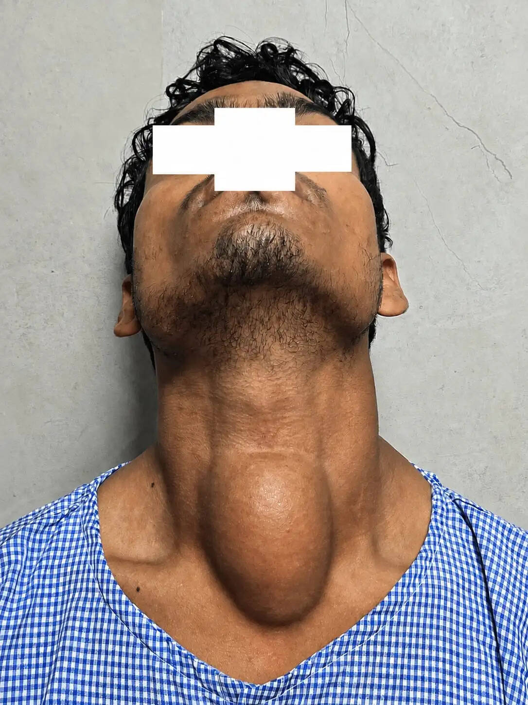 लखीमपुर मेडिकल कॉलेज मरीज के लिए बना संजीवनी, गले की जटिल गांठ की हुई सफल सर्जरी