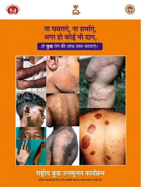 मुरादाबाद में कुष्ठ रोगी खोज अभियान 9 मार्च से , घर-घर ढूंढे जाएंगे मरीज