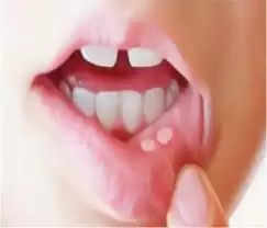 mouth ulcers