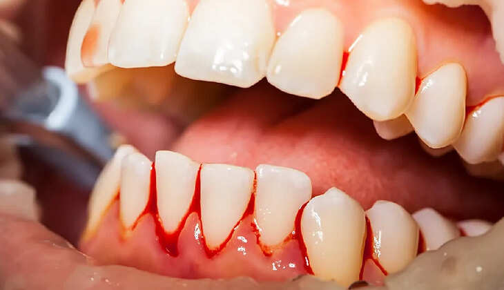 bleeding-gums